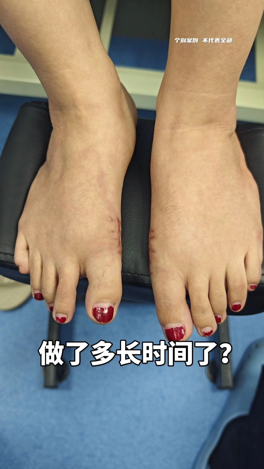 乐鱼体育入口-关于JJJ正式接受脚趾手术三个月后重新评估的信息
